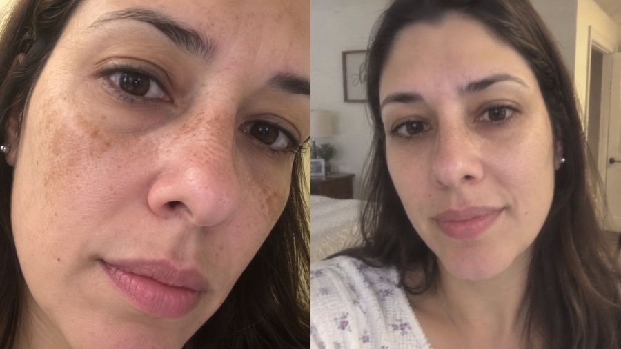 Antes e depois do tratamento com Hidra Cream