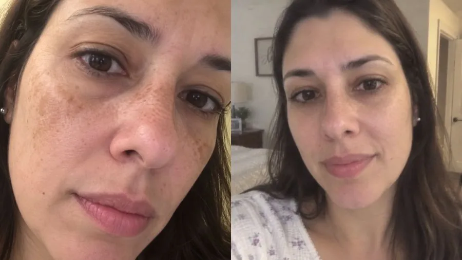 Antes e depois do tratamento com Hidra Cream
