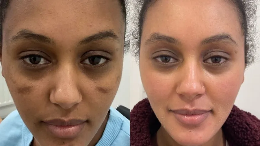 Antes e depois do tratamento com Hidra Cream