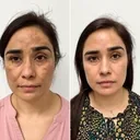 Antes e depois do tratamento com Hidra Cream