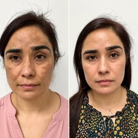 Antes e depois do tratamento com Hidra Cream