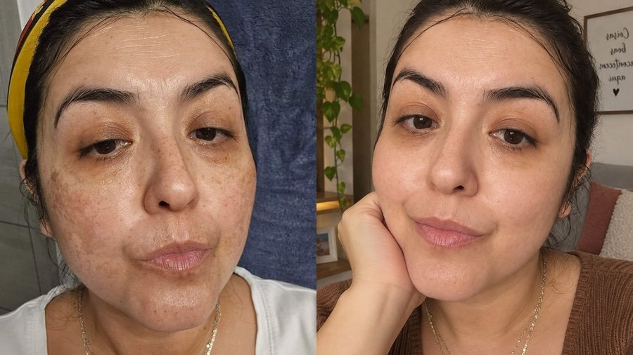 Antes e depois do tratamento com Hidra Cream