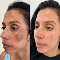 Antes e depois do tratamento com Hidra Cream