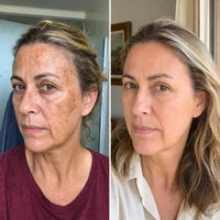Antes e depois do tratamento com Hidra Cream