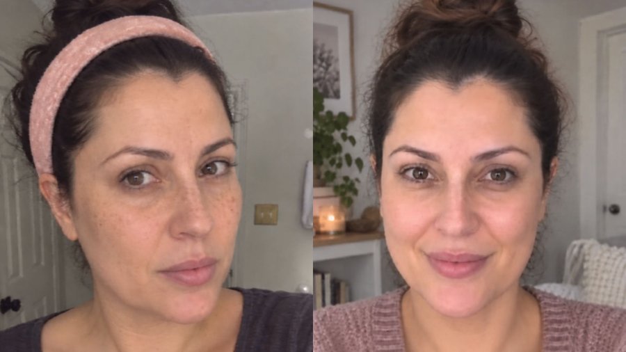 Antes e depois do tratamento com Hidra Cream